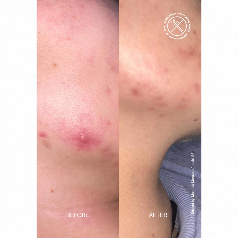 Zitcontrol Blemish Control Moisturizer