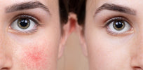 1916729-980x480c-Rosacea Hautkrankheit
