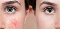 1916729-980x480c-Rosacea Hautkrankheit