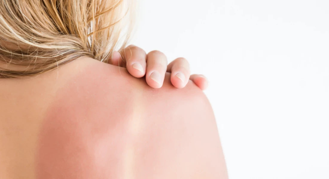 header-wat-te-doen-als-je-toch-verbrand-bent