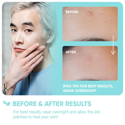 BreakoutAid Emergency Dots For Spots and Blemishes Tea Tree Oil