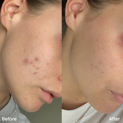 Clay And Glow Spot Treatment Gel